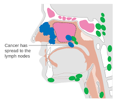 The doctor will take a history and examine the patient. File Diagram Showing Nasal Cavity Cancer That Has Spread To The Lymph Nodes Cruk 171 Svg Wikimedia Commons