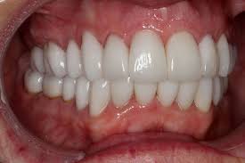 I Couldn'T See Any Visible Changes Until I Took Photos. Here'S Tray 1/14 Vs  6/14 To Widen And Fix My Canted Teeth. The Cant Mostly Gets Fixed In The  Last 5 Trays