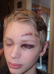 My brother took a bat to the head