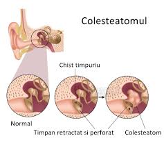 Ca dopurile sunt proaste, nu urechile. Colesteatomul