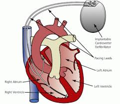 Image result for Internal Cardiac Defibrillator