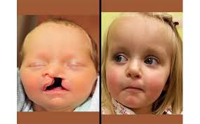 Image result for Cleft Lip