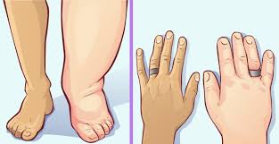 It then creates swelling in the extremities such as the legs, hands. How To Reduce Water Retention Fast