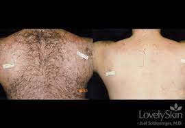 Speaking of sessions, laser hair removal is not a one and done process. Laser Hair Removal Omaha Cosmetic Surgery Skin Specialists Pc Lovelyskin