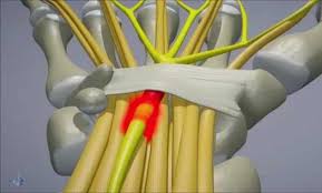 Для просмотра онлайн кликните на видео ⤵. Sindrom De Canal Carpian Pret Interventie Chirurgicala Sindrom Tunel Carpian
