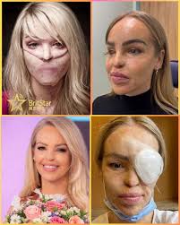 💛 “For a long time I felt like I'd reached the end of the road with my  eye.” Sixteen years after a life-changing ordeal, Katie Piper is stepping  into a new chapter —