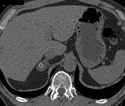 Ct is commonly used to detect and characterize adrenal masses. Adrenal Imaging With Multidetector Ct Evidence Based Protocol Optimization And Interpretative Practice Radiographics