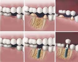 Dental Implant Vs Bridge Options For Missing Teeth Check Out Www Bvoms Com For Tooth Replacemen Dental Implants Tooth Implant Cost Tooth Extraction Aftercare
