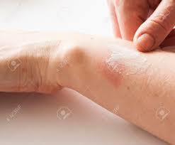 Fig 1 volar view of the right hand fig 2 dorsal view of the right hand ### 1… A Woman Applying Scars Removal Cream To Heal The First Degree Heat Burn Wound On Her Hand Stock Photo Picture And Royalty Free Image Image 132754869