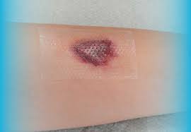 Image result for Skin Tear