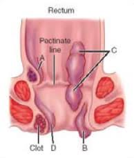 hemorrhoids causes treatment and prevention