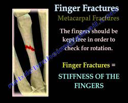 Please tell any therapy and exercise to heal it. answered by dr. Finger Fractures Dr Nabil Ebraheim S Blog