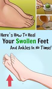 Here S How To Heal Your Swollen Feet And Ankles In No Time Swollen Feet Remedy Foot Remedies Swollen Feet