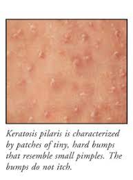 Ingrown hair refers to a hair follicle that grows inward into the skin, often, after shaving or waxing, the hair curls back as it grows and lengthens towards the skin. Keratosis Pilaris
