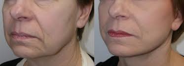 A lower facelift surgically redefines the jawline by eliminating jowls, minimizes the appearance of laugh or marionette lines, and tightens sagging cheeks. Lift Up Your Jowls And Smile Lower Facial Rejuvenation Strategies Skin Md Seattle