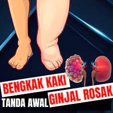 Adakah anda mengalami ruam dan kegatalan? Bh Pinggang Sihat Jangan Ambil Mudah Bila Kaki Sudah Bengkak Ianya Tanda Buah Pinggang Bocor Habis Bengkak Kaki Boleh Terjadi Di Mana Mana Bahagian Kaki Termasuklah Tapak Kaki Buku Lali