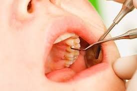Can a loose tooth be fixed? How To Tighten Loose Teeth Naturally Top Home Remedies For Loose Tooth Repair Loose Tooth Tooth Replacement Tooth Repair