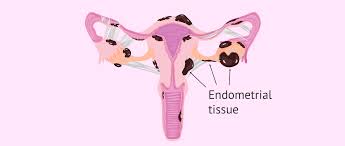 When endometriosis involves the ovaries, cysts called endometriomas may form. Severe Endometriosis With Chocolate Cysts