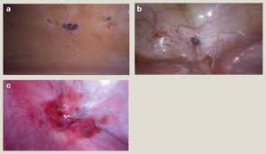 Aug 17, 2021 · endometriosis is an often painful condition that occurs when the endometrium, or the membrane that lines the uterus, grows outside the uterus. Endometriosis Update Obstetrics Gynaecology And Reproductive Medicine