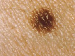 moles types causes treatment and diagnosis