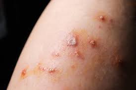 Top 6 signs and symptoms of gangrene disease in legs and hands is going to present 6 common symptoms that you should know. 529 Best Gangrene Images Stock Photos Vectors Adobe Stock