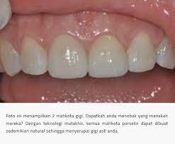 Gigi tiruan ini disebut pontic dan digabungkan dengan 2 mahkota gigi. Mahkota Gigi Tiruan Dan Jembatan Gigi The Implant And Oral Surgery Centre