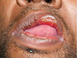 Image result for Primary Syphilis