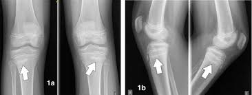 Image result for Tibia Stress Fracture