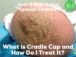 When a toddler has cradle cap on their scalp it may be a source of agony for the parents. What Is Cradle Cap And How Do I Treat It With Pure Coconut Oil Read It