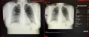 Image result for lung cancer xray
