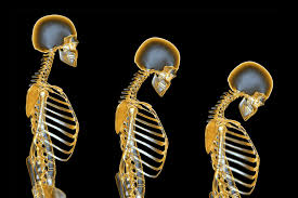 This disparity may be due to the deficiency of the estrogen hormone, loss of bone at a younger age, and loss of bone at a more rapid pace. Pictures Of Osteoporosis