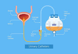 Image result for Urethral Catheterization