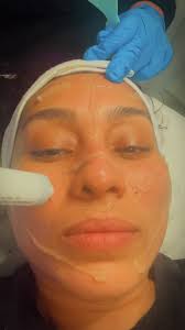 Protocolo de carboxiterapia