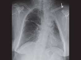 The poland syndrome is defined by: Jaypeedigital Ebook Reader