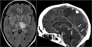 Cerebral venous sinus thrombosis in early pregnancy: The Radiology Assistant Cerebral Venous Thrombosis
