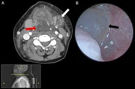 Image result for Sialoadenitis