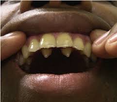 Image result for Gardner Sendromu