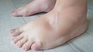 أسباب انتفاخ القدمين واليدين والوجه - ويب طب