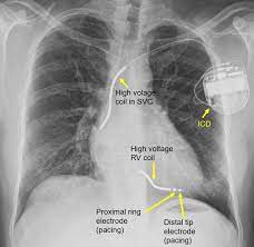 Icds are best distinguished from pacemakers on cxr by coils that appear as thickened icd vs pacemaker. Cardiac Implantable Electronic Devices Cied On Cxr
