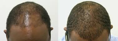 A 41 year old somalian man with a 10 year history of male pattern hair loss in the temples has one session. African American Hair Transplant In Miami Care4hair