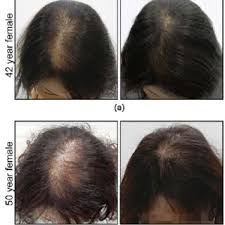 Some females may also experience increased hair loss at first when using minoxidil. Pdf Combination Therapy To Treat Asian Female Pattern Hair Loss
