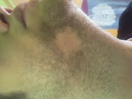 Alopecia universalis is often shortened to au and it also goes by the name alopecia areata universalis. Alopecia Areata Deximed
