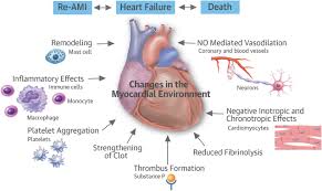 Image result for acute myocardial infarction