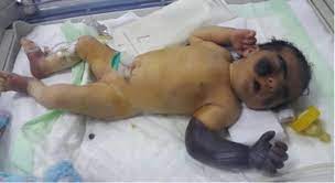 (1) large purpuric ecchymotic areas of the skin, (2) fever and (3) hypotension. Neonatal Purpura Fulminans In Newborn With Severe Congenital Protein C Deficiency Case Report Sciencedirect