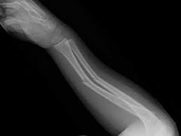 Image result for Growth Plate