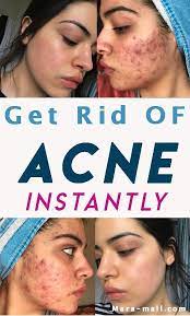 Get Rid Of Acne Instantly How To Get Rid Of Acne Acne Marks How To Get Rid Of Pimples