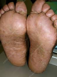 Image result for pompholyx soles of feet