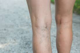 Are My Varicose Vein Treatments Permanent
