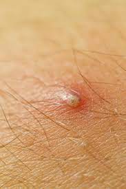 We want that sucker out! How To Treat Ingrown Eyebrow Hair With Home Remedies