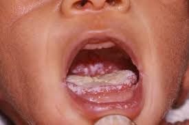 Lidah putih pada bayi merupakan dampak dari meningkatnya pertumbuhan jamur yang disebut candida albicans. Oral Thrush Mouth Thrush Nhs